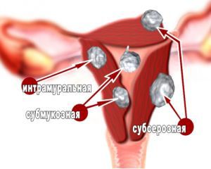 Серозная аденокарцинома матки (шейки и тела): лечение, прогноз, причины, признаки, симптомы