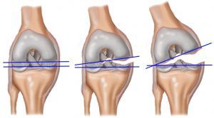 Растяжение голеностопного сустава и посттравматические артриты голеностопного сустава