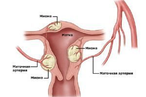 Фибромиома матки, лечение, симптомы, признаки, причины
