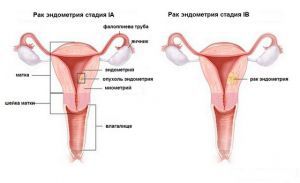 Эндометриоидная аденокарцинома с плоскоклеточной дифференцировкой 9