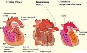Врожденный порок сердца: лечение, причины, классификация, диагностика, симптомы, признаки, профилактика