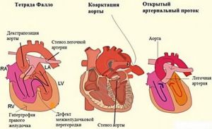 Врожденный порок сердца: лечение, причины, классификация, диагностика, симптомы, признаки, профилактика Врожденный порок сердца: лечение, причины, классификация, диагностика, симптомы, признаки, профилактика