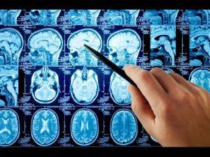 Псевдоопухоль головного мозга: что это такое, симптомы, лечение, причины, признаки Псевдоопухоль головного мозга: что это такое, симптомы, лечение, причины, признаки