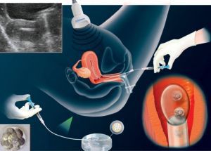 Перенос эмбрионов при ЭКО для беременности