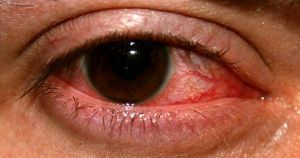 Герпетический кератит глаза: лечение, профилактика, симптомы, причины
