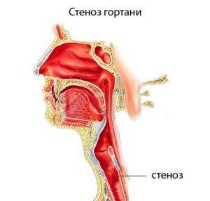 Стенозы гортани и трахеи: причины, лечение, симптомы, признаки