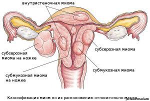 Рак тела матки: стадии, симптомы, лечение, диагностика