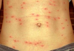 Сыпной тиф: профилактика, диагностика, лечение, симптомы, причины, признаки