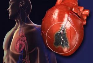 Некоронарогенные некрозы миокарда Некоронарогенные некрозы миокарда