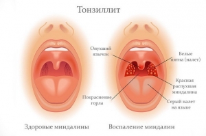 Тонзиллит: что это такое, причины, лечение, симптомы, признаки