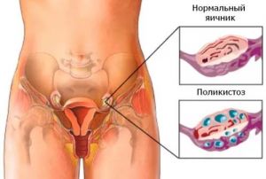 СПКЯ (синдром поликистозных яичников): что это такое, лечение, признаки, симптомы, причины