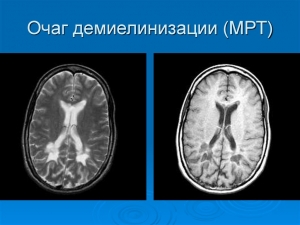 Демиелинизация головного мозга: что это такое, очаги