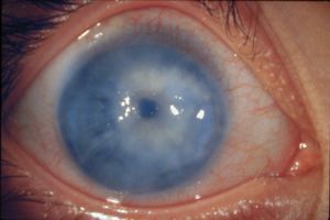 Вторичная глаукома глаза: лечение, причины, классификация, симптомы, признаки