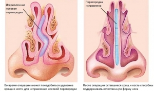 Искривление перегородки носа: операция по исправлению, лечение после операции