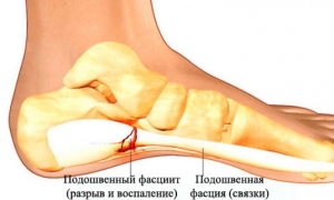 Подошвенный фасцит ступни: что это такое, лечение, симптомы, причины, признаки