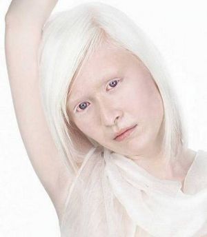 Альбинизм у человека, глазной