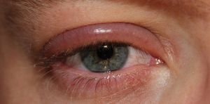 Заболевания век глаз человека: лечение, профилактика, симптомы, признаки, причины