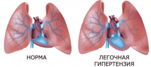 Легочная гипертензия: лечение, степени, симптомы, причины, признаки