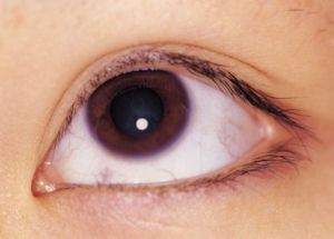 Краевой кератит глаза: лечение, причины, симптомы