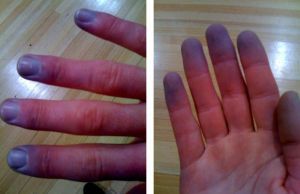 Общий цианоз: симптомы, признаки, причины, лечение Общий цианоз: симптомы, признаки, причины, лечение