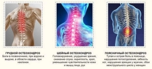 Заболевания грудного отдела позвоночника: причины, лечение, симптомы, признаки Заболевания грудного отдела позвоночника: причины, лечение, симптомы, признаки
