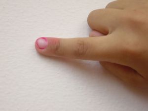 Паронихия пальца руки: лечение в домашних условиях, причины