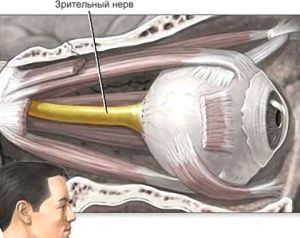 Ишемическая нейропатия зрительного нерва: лечение, симптомы