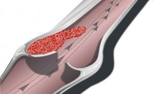 Острый тромбоз артерий нижних конечностей
