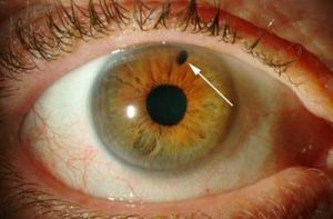 Закрытоугольная глаукома: лечение, симптомы, причины, признаки