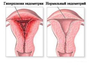 Гиперплазия эндометрия без атипии (простая и комплексная): что это такое, лечение, признаки, причины, симптомы