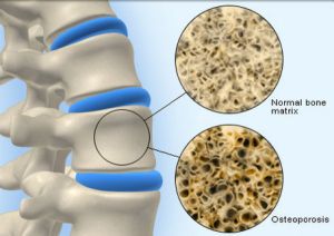Остеопороз костей: что это такое, лечение, симптомы, причины, признаки, профилактика, диагностика
