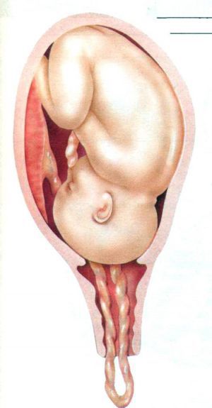 Непереносимость родов: упадок сердечной деятельности плода, выпадение и сдавление пуповины