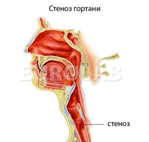 Острый стеноз гортани: лечение, неотложная помощь, причины, симптомы, признаки