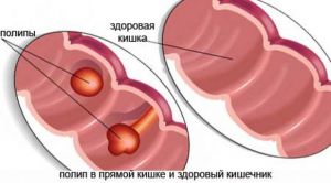 Семейный аденоматозный полипоз толстой кишки: что это такое, лечение, причины, симптомы, признаки