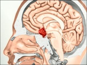 Пролактинома гипофиза: симптомы, лечение, признаки, причины