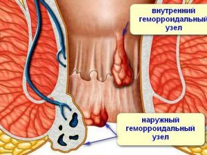 Геморрой при беременности: что делать, лечение, симптомы, признаки, профилактика