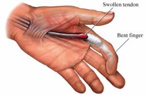 Щелкающий палец: причины, лечение,  симптомы,  признаки, профилактика