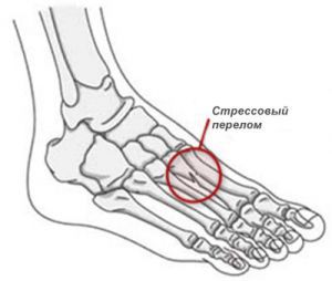 Стрессовый перелом