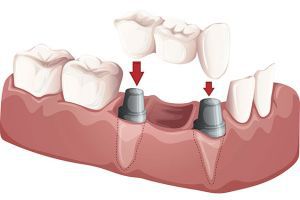 Стоматологические устройства: мосты, съемные частичные и полные зубные протезы