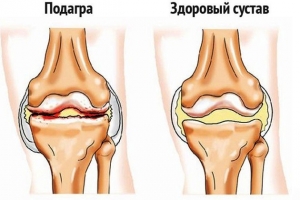 Псевдоподагра: что это такое, лечение, причины, симптомы, признаки