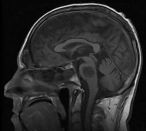 Понтинный миелиноз головного мозга: симптомы, признаки, причины, лечение