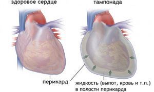 Перикардиальный выпот и тампонада сердца