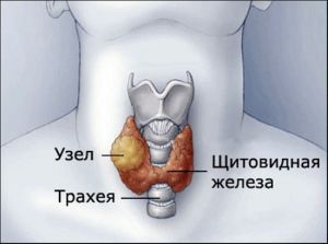 Узловой зоб щитовидной железы: лечение, симптомы, признаки, причины