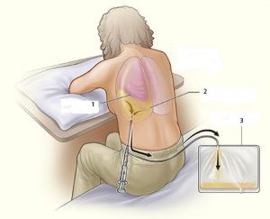 Хилоторакс: лечение, классификация, причины, симптомы, признаки