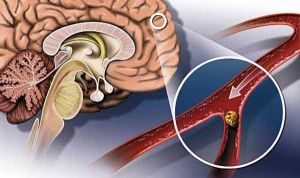 Последствия ишемического инсульта головного мозга