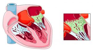 Инфекционный миокардит: что это такое, симптомы, лечение, признаки, причины