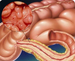 Воспалительные заболевания кишечника: симптомы, диагностика, лечение