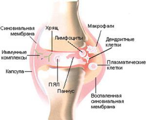 Дизентерийный (последизентерийный) артрит