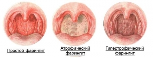 Острый фарингит: что это такое, причины, лечение, симптомы, признаки