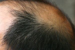 Алопеция волос: лечение, причины, симптомы, признаки